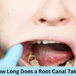 How Long Does a Root Canal Take?