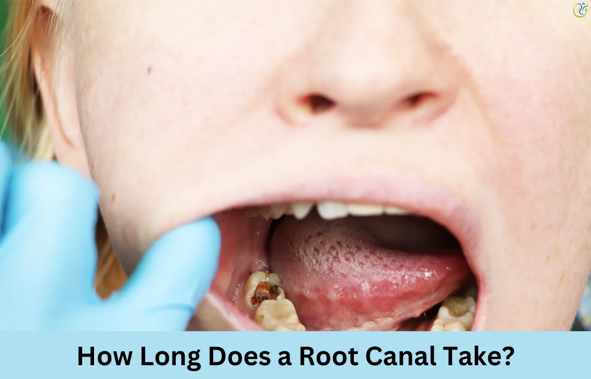 How Long Does a Root Canal Take?