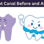 Root Canal Before and After