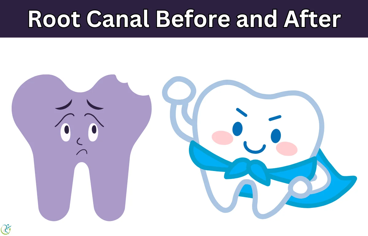 Root Canal Before and After