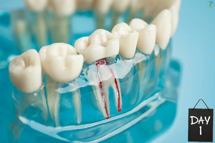 Root Canal Recovery Timeline